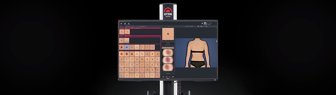 FotoFinder ATBM® Master – a breakthrough in melanoma diagnostics
