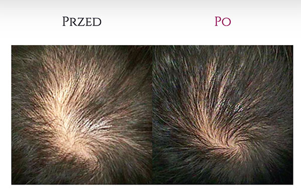 leczenie łysienia dr cyj hair filler